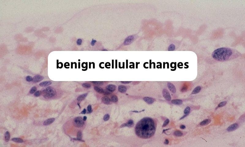 معنی جمله benign cellular changes چیست؟.jpg